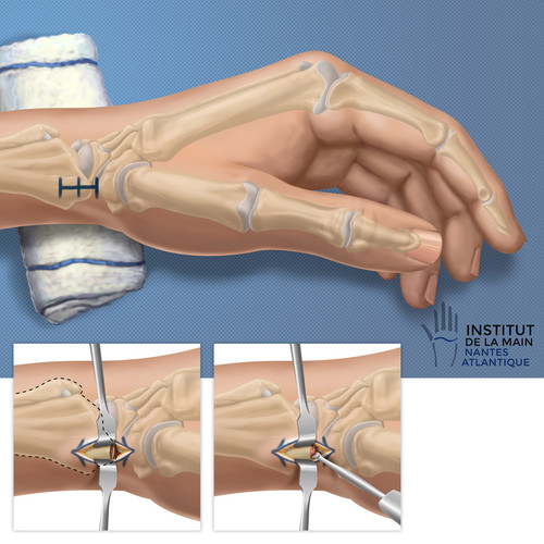 Illustrations chirurgicales de main