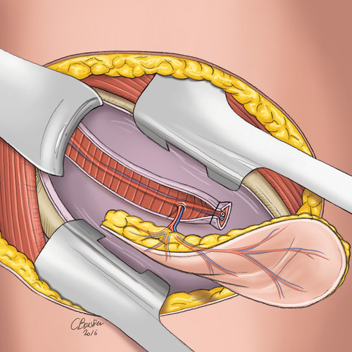 Illustration de lambeaux cutanés et vascularisation