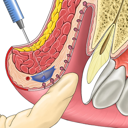 Injection profonde dans la lèvre supérieure