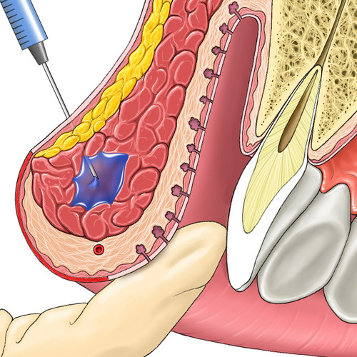 Injection superficielle dans la lèvre supérieure