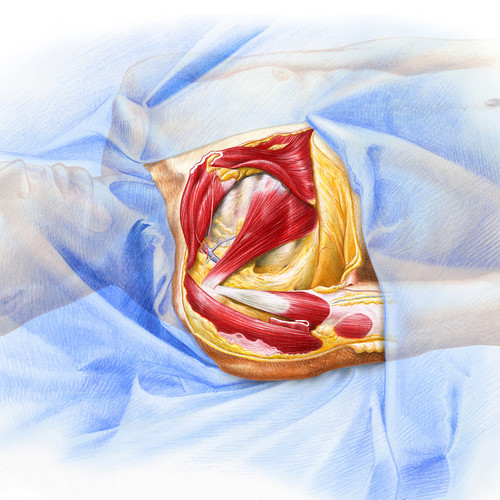 Illustration de dissection de fosse axillaire