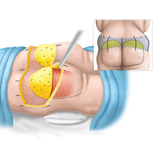 Illustrations de chirurgie Lower body lift