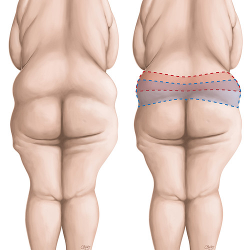 Illustrations de morphologie de patients obèses après un fort amaigrissement