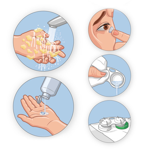 Illustrations didactiques de pose de lentilles