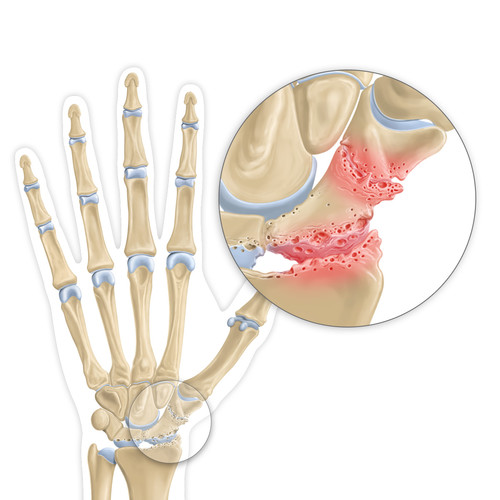 Illustrations d'arthose du poignet