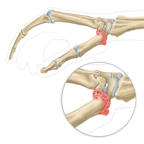 Illustration d'arthrose du pouce