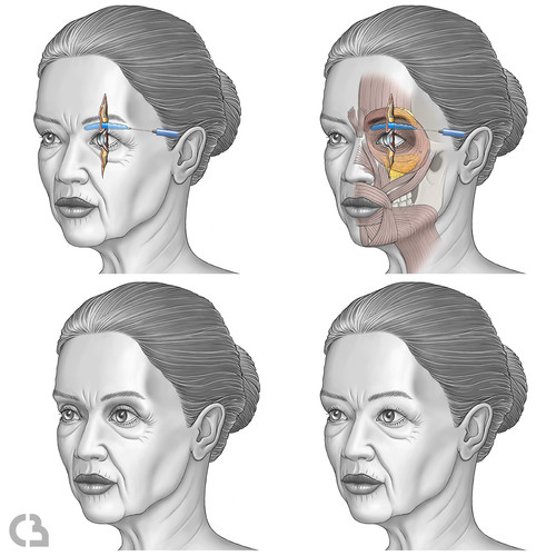 illustration de visgaes et injections périorbitaires