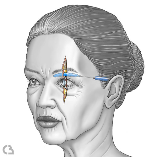 Illustration du visage et profondeur d'injection